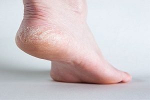 روش های درمان خشکی کف پا