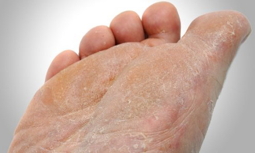 روش های درمان خشکی کف پا