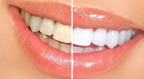چه خوراکی هایی باعث زردی دندان می شود؟