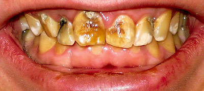 علائم فلوئوروزيس دنداني